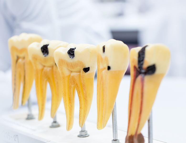 文京区（茗荷谷・江戸川橋）の歯医者、吉澤歯科クリニックのむし歯治療