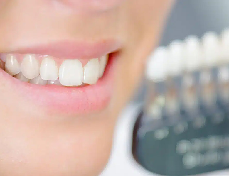 文京区（茗荷谷・江戸川橋）の歯医者、吉澤歯科クリニックのホワイトニング