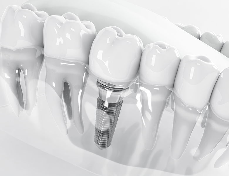 文京区（茗荷谷・江戸川橋）の歯医者、吉澤歯科クリニックのインプラント