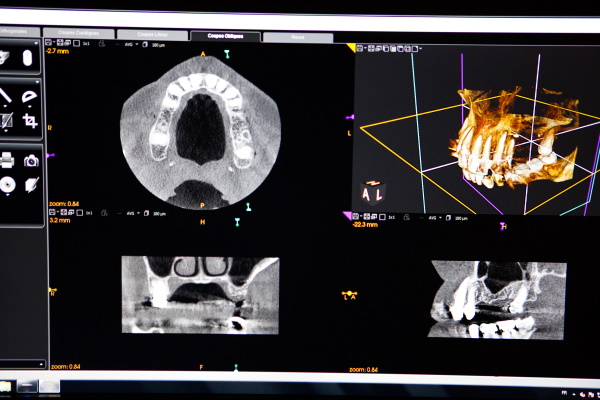 文京区（茗荷谷・江戸川橋）の歯医者、吉澤歯科クリニックの親知らずの抜歯