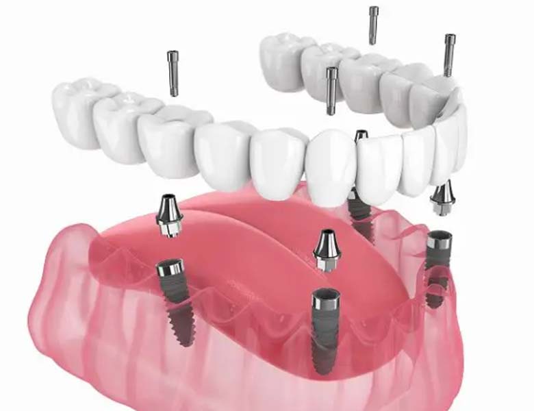 文京区（茗荷谷・江戸川橋）の歯医者、吉澤歯科クリニックのインプラント