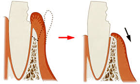 文京区（茗荷谷・江戸川橋）の歯医者、吉澤歯科クリニックのむし歯治療