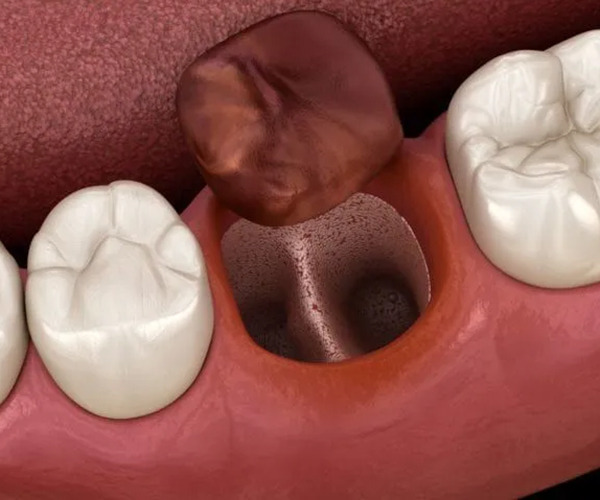 文京区（茗荷谷・江戸川橋）の歯医者、吉澤歯科クリニックの親知らずの抜歯