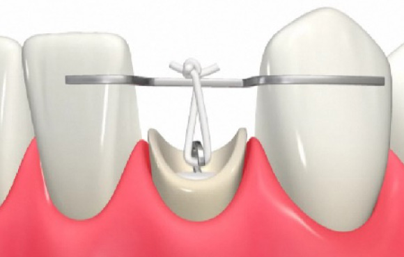 文京区（茗荷谷・江戸川橋）の歯医者、吉澤歯科クリニックのむし歯治療