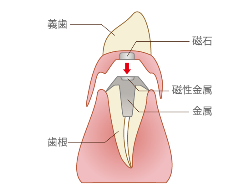 文京区（茗荷谷・江戸川橋）の歯医者、吉澤歯科クリニックの入れ歯治療