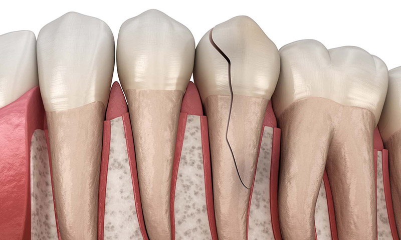 文京区（茗荷谷・江戸川橋）の歯医者、吉澤歯科クリニックの歯ぎしり・食いしばり