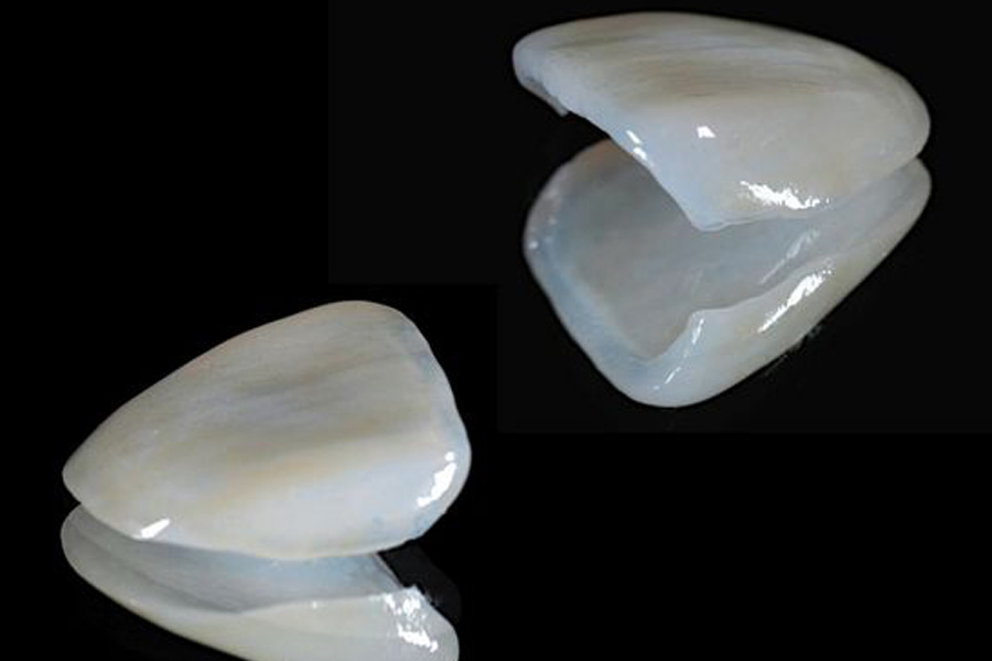 文京区（茗荷谷・江戸川橋）の歯医者、吉澤歯科クリニックの審美歯科治療