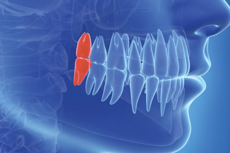 文京区（茗荷谷・江戸川橋）の歯医者、吉澤歯科クリニックの親知らずの抜歯