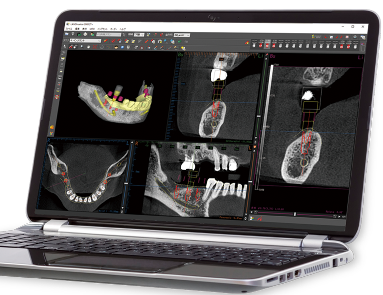 文京区（茗荷谷・江戸川橋）の歯医者、吉澤歯科クリニックのインプラント