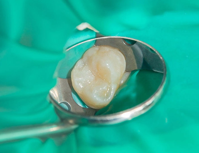 文京区（茗荷谷・江戸川橋）の歯医者、吉澤歯科クリニックの根管治療