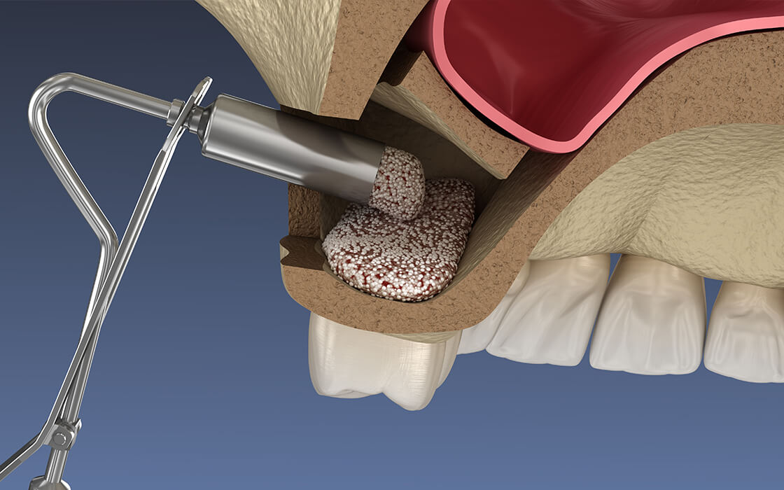 文京区（茗荷谷・江戸川橋）の歯医者、吉澤歯科クリニックのインプラント