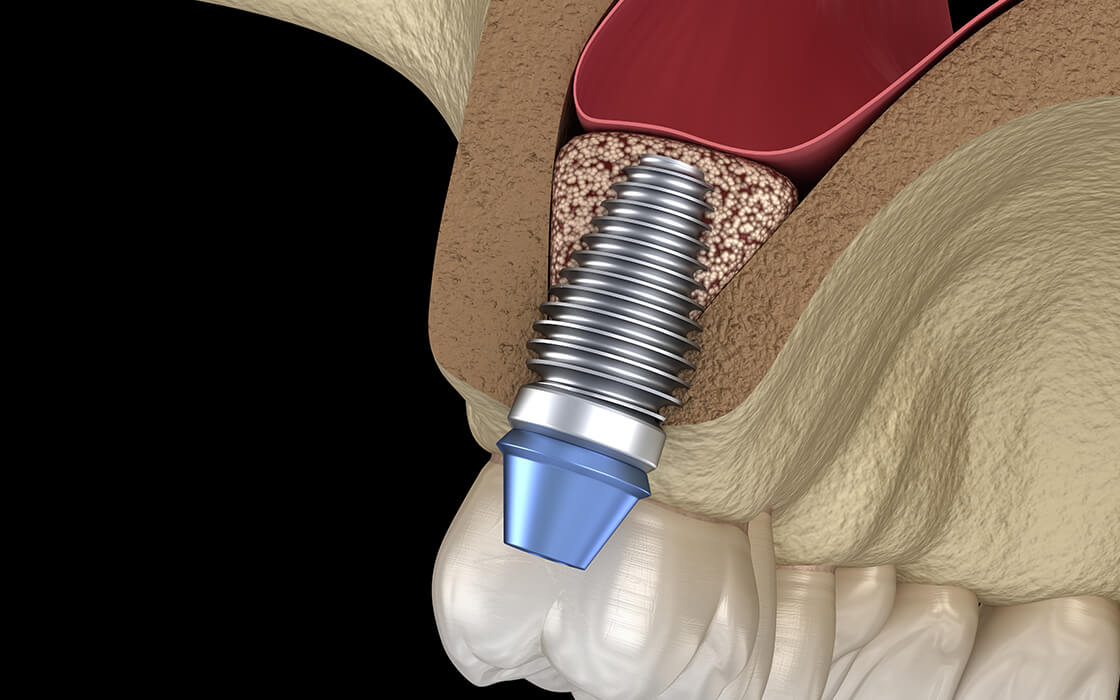 文京区（茗荷谷・江戸川橋）の歯医者、吉澤歯科クリニックのインプラント